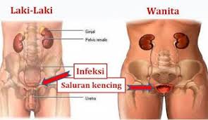 Jual Obat Sipilis De Nature Di Sanggau