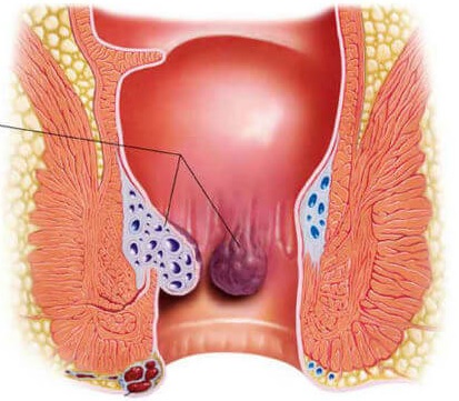 Jual Ambejoss Salep Salwa Obat Wasir De Nature Di Kudus