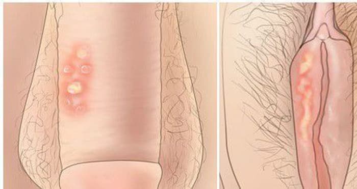 Jual Obat Sipilis De Nature Di Wonogiri