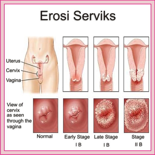 Jual Obat Sipilis De Nature Di Yahukimo