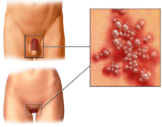 Jual Obat Sipilis De Nature Di Tebo