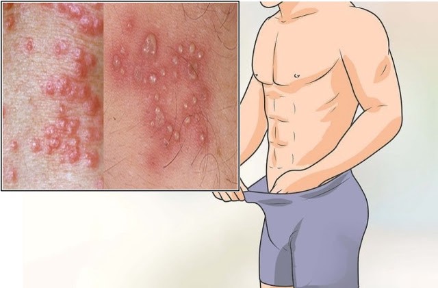 Jual Obat Sipilis De Nature Di Sleman